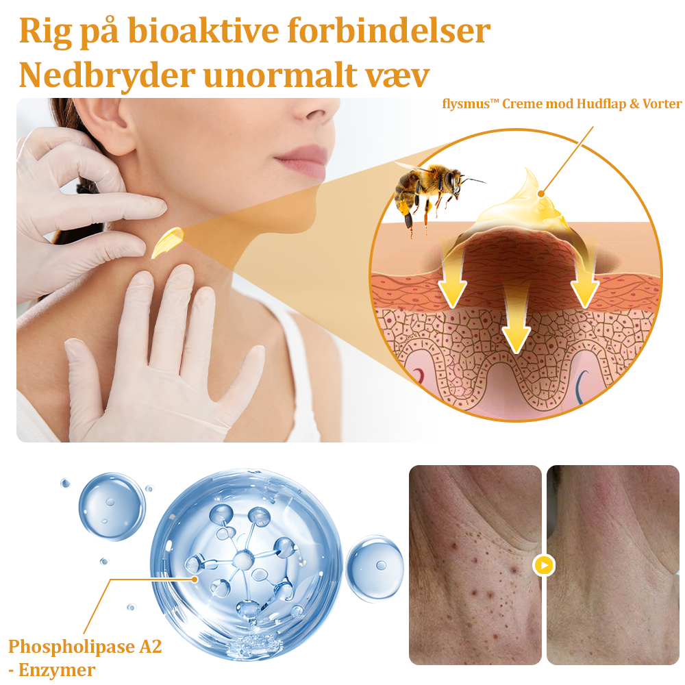🎁flysmus™ Creme mod Hudflap & Vorter, Hjælper med at behandle vedvarende vorter, hudvækster, hudlæsioner, infektioner, ardannelse og udglatte ujævn hud❤️