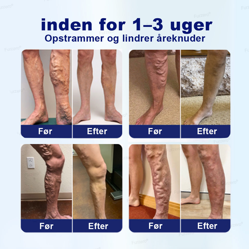 🔥Lavet og sendt fra Danmark🌿Furzero® VeinFreedom Urte-spray - Mikrotåge-terapi