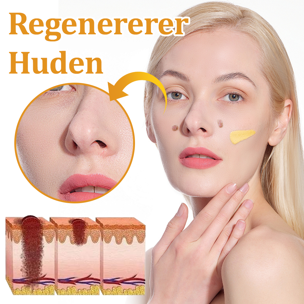 🎁flysmus™ Creme mod Hudflap & Vorter, Hjælper med at behandle vedvarende vorter, hudvækster, hudlæsioner, infektioner, ardannelse og udglatte ujævn hud❤️