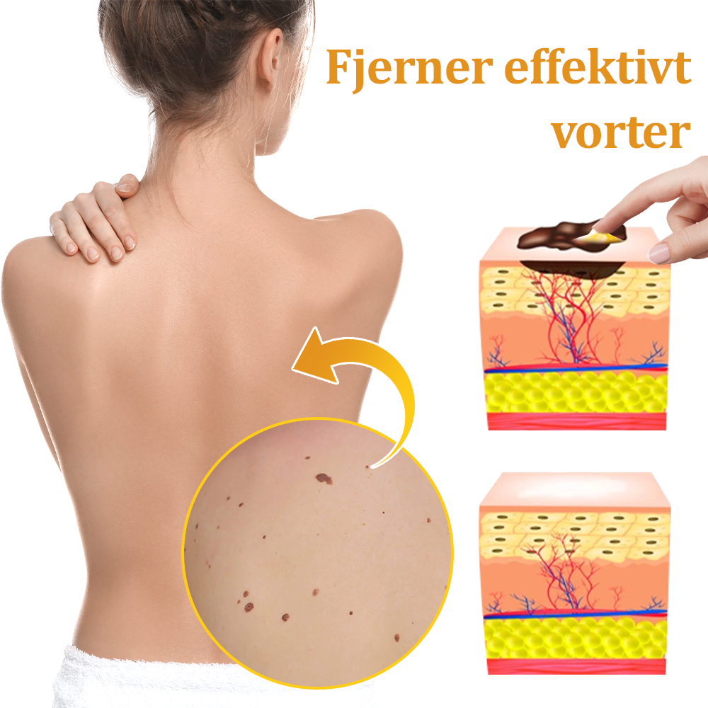 🎁flysmus™ Creme mod Hudflap & Vorter, Hjælper med at behandle vedvarende vorter, hudvækster, hudlæsioner, infektioner, ardannelse og udglatte ujævn hud❤️