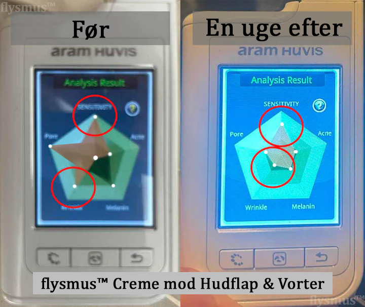 🎁flysmus™ Creme mod Hudflap & Vorter, Hjælper med at behandle vedvarende vorter, hudvækster, hudlæsioner, infektioner, ardannelse og udglatte ujævn hud❤️