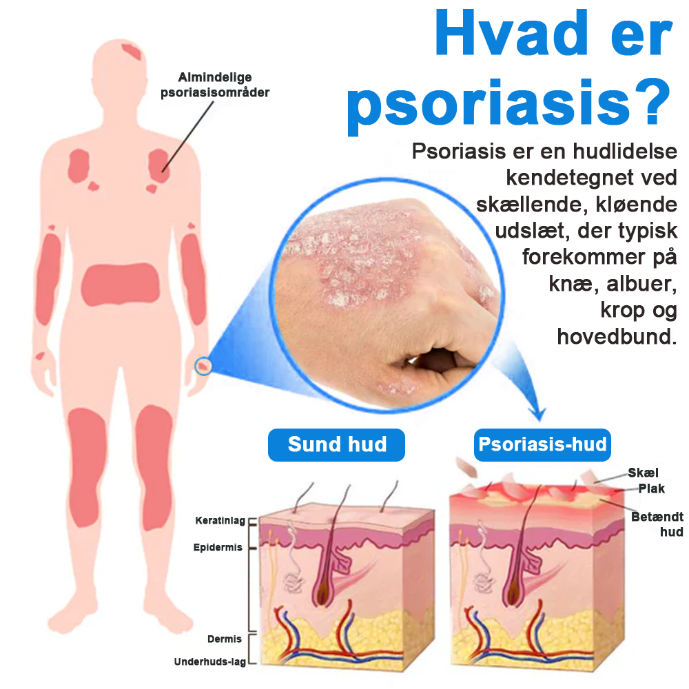 ✅ Officiel butik: Zvoevo® Magnesium Urte-psoriasis Spray(Lindrer psoriasis og eksem, forbedrer bakterielle infektioner i intimområdet, behandler akne og vorter, lindrer ledsmerter og nervesmerter)