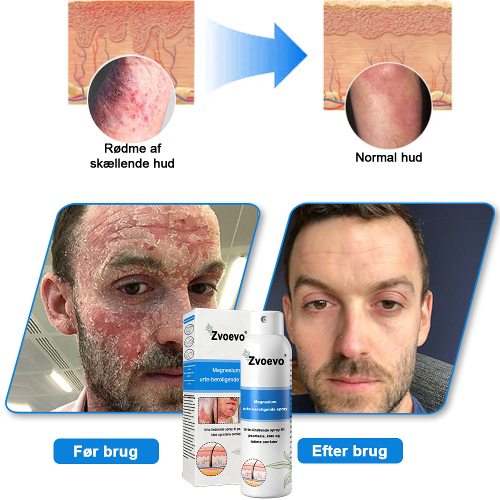 ✅ Officiel butik: Zvoevo® Magnesium Urte-psoriasis Spray(Lindrer psoriasis og eksem, forbedrer bakterielle infektioner i intimområdet, behandler akne og vorter, lindrer ledsmerter og nervesmerter)