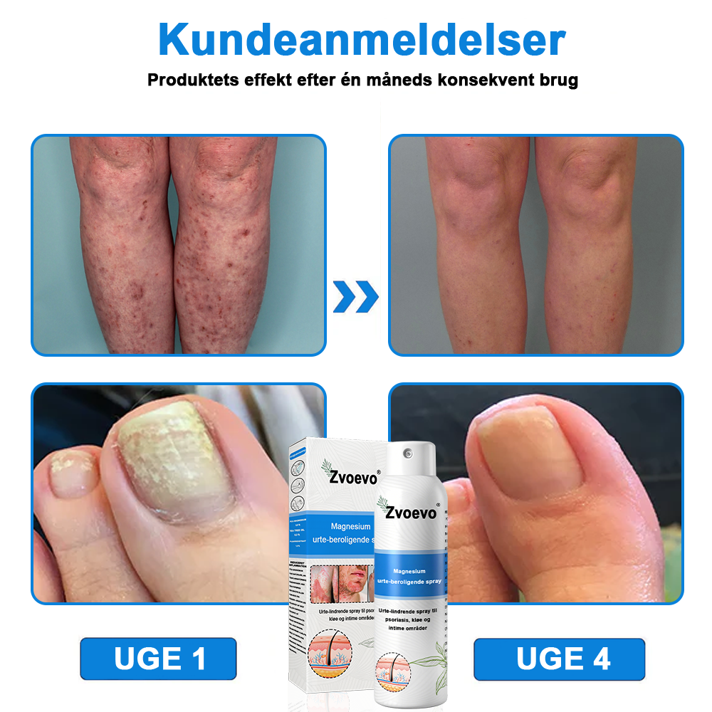✅ Officiel butik: Zvoevo® Magnesium Urte-psoriasis Spray(Lindrer psoriasis og eksem, forbedrer bakterielle infektioner i intimområdet, behandler akne og vorter, lindrer ledsmerter og nervesmerter)