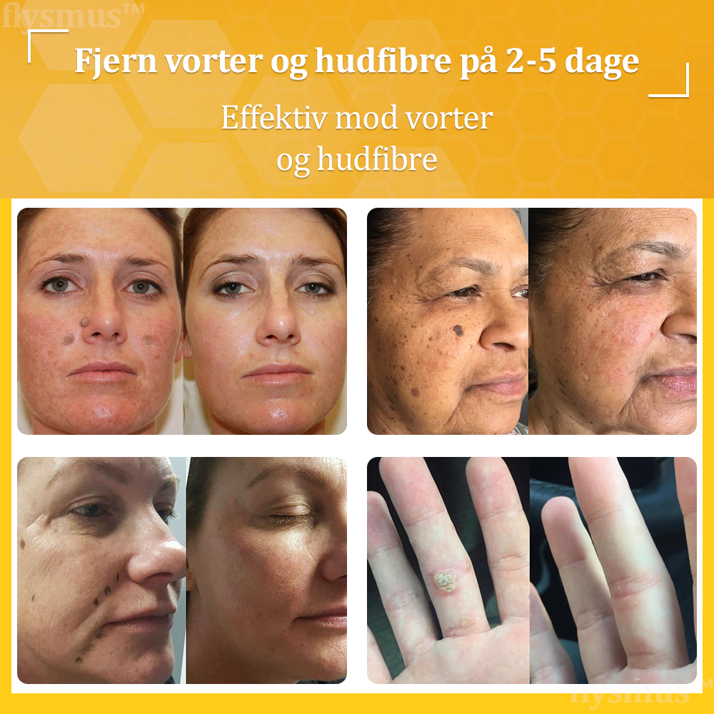 🎁flysmus™ Creme mod Hudflap & Vorter, Hjælper med at behandle vedvarende vorter, hudvækster, hudlæsioner, infektioner, ardannelse og udglatte ujævn hud❤️