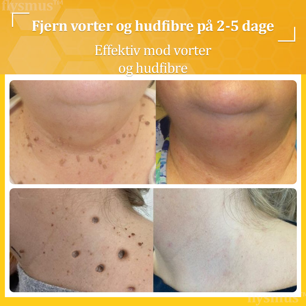 🎁flysmus™ Creme mod Hudflap & Vorter, Hjælper med at behandle vedvarende vorter, hudvækster, hudlæsioner, infektioner, ardannelse og udglatte ujævn hud❤️