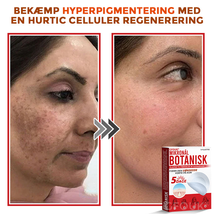 GFOUK® Botanisk Mikronålplaster til fjernelse af hudmærker (danish)