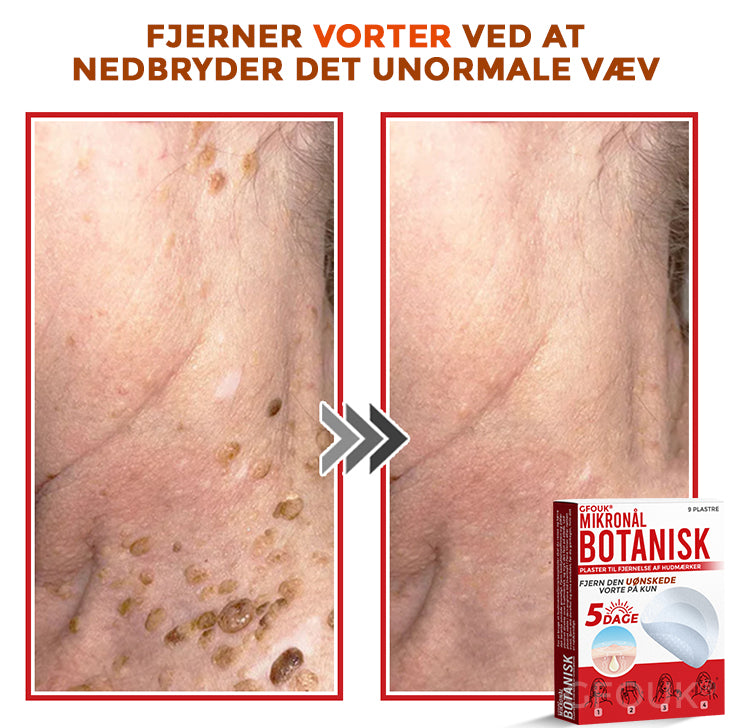 GFOUK® Botanisk Mikronålplaster til fjernelse af hudmærker (danish)