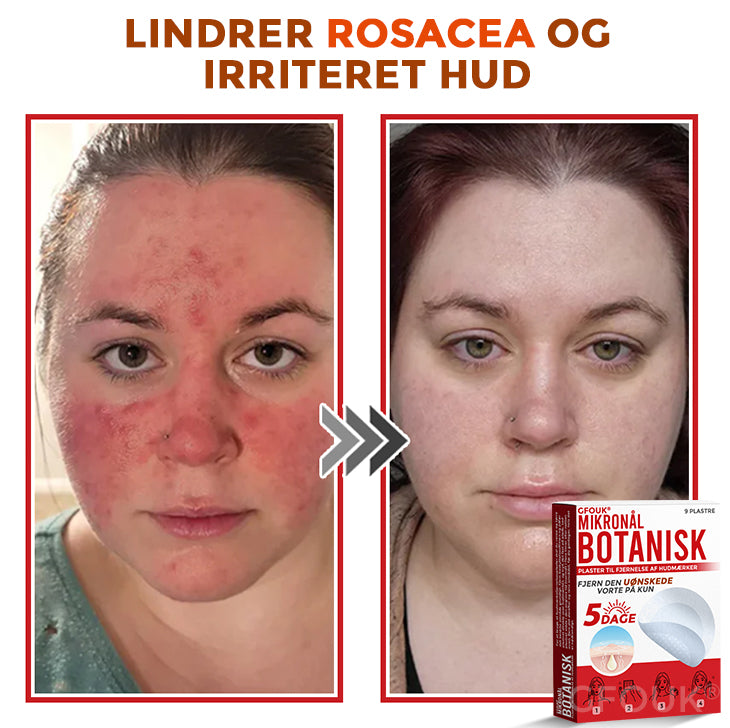 GFOUK® Botanisk Mikronålplaster til fjernelse af hudmærker (danish)
