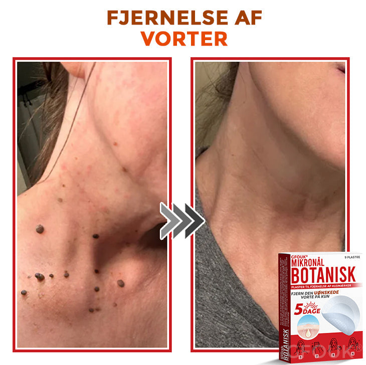 GFOUK® Botanisk Mikronålplaster til fjernelse af hudmærker (danish)