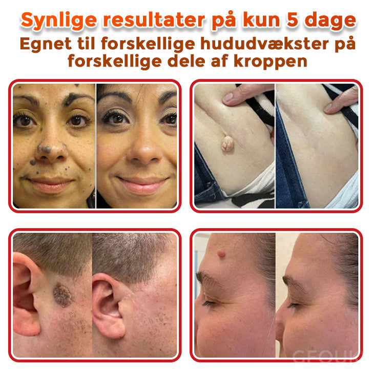 GFOUK® Botanisk Mikronålplaster til fjernelse af hudmærker (danish)