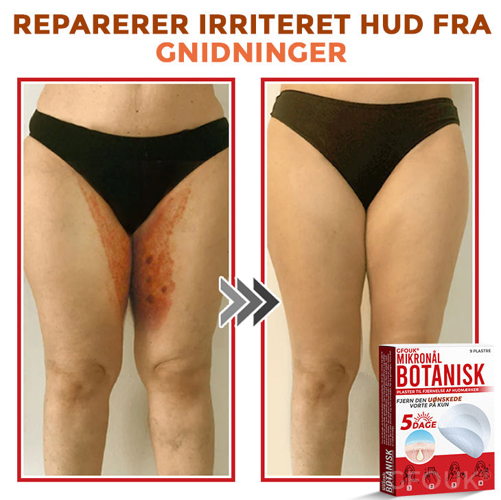 GFOUK® Botanisk Mikronålplaster til fjernelse af hudmærker (danish)