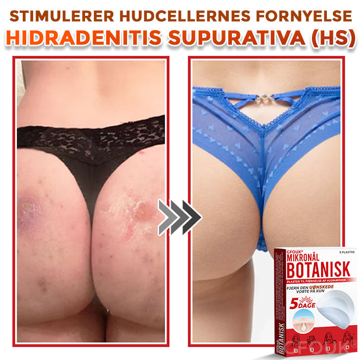 GFOUK® Botanisk Mikronålplaster til fjernelse af hudmærker (danish)