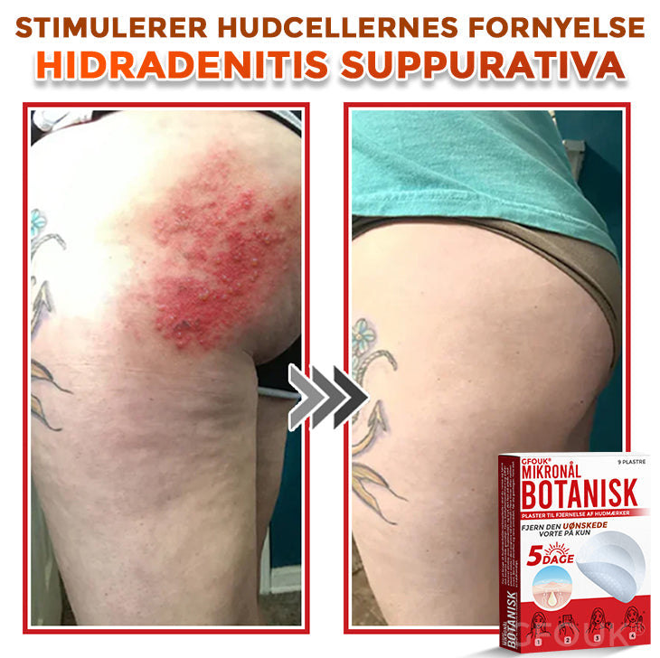 GFOUK® Botanisk Mikronålplaster til fjernelse af hudmærker (danish)