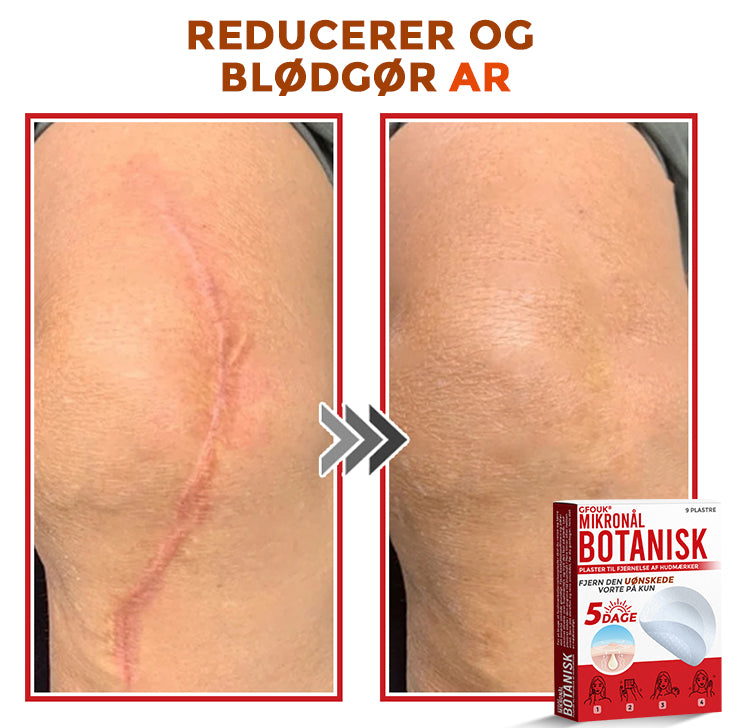 GFOUK® Botanisk Mikronålplaster til fjernelse af hudmærker (danish)