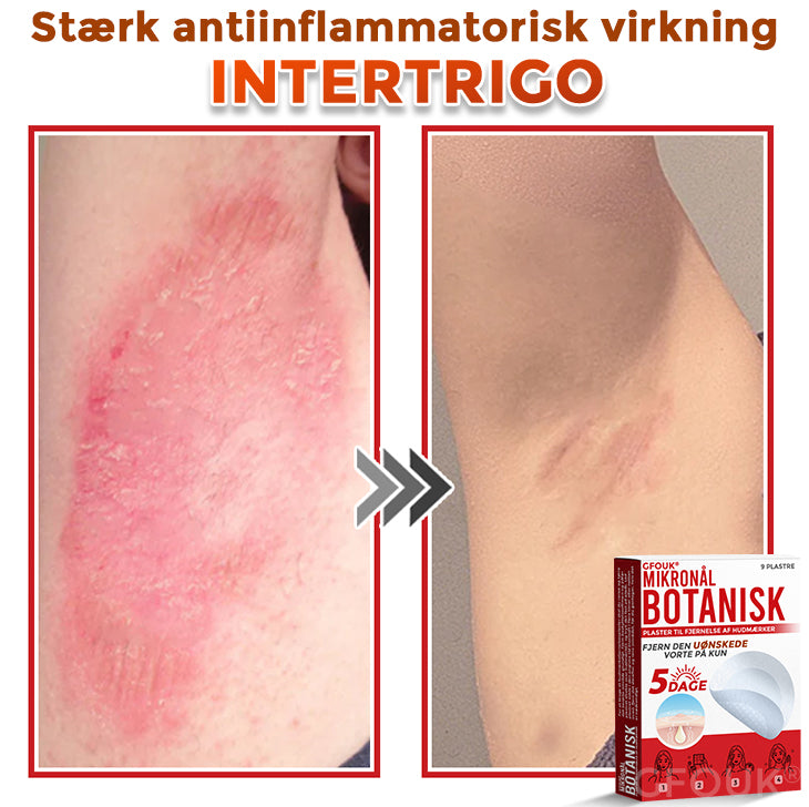 GFOUK® Botanisk Mikronålplaster til fjernelse af hudmærker (danish)