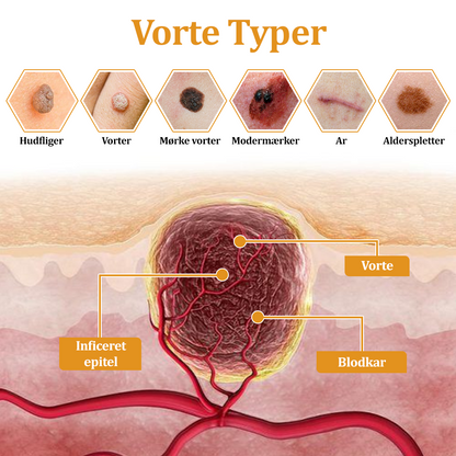 🧑‍⚕️flysmus™ Creme mod Hudflap & Vorter, Hjælper med at behandle vedvarende vorter, hudvækster, hudlæsioner, infektioner, ardannelse og udglatte ujævn hud✨