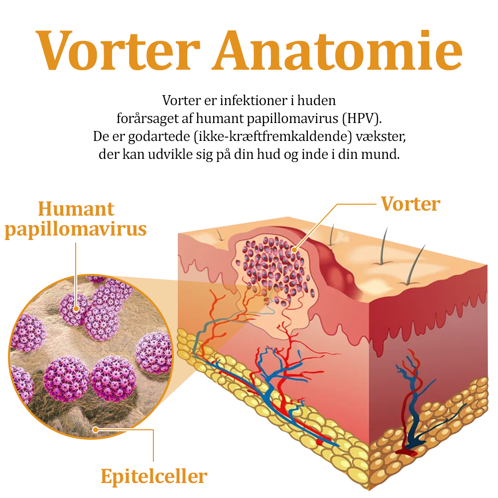 🧑‍⚕️flysmus™ Creme mod Hudflap & Vorter, Hjælper med at behandle vedvarende vorter, hudvækster, hudlæsioner, infektioner, ardannelse og udglatte ujævn hud✨