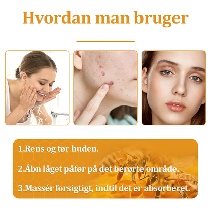 🧑‍⚕️flysmus™ Creme mod Hudflap & Vorter, Hjælper med at behandle vedvarende vorter, hudvækster, hudlæsioner, infektioner, ardannelse og udglatte ujævn hud✨