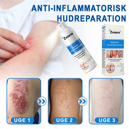 ✅ Officiel butik: Zvoevo® Magnesium Urte-psoriasis Spray (Lindrer psoriasis og eksem, behandler rosacea og akne, forbedrer bakterielle infektioner i kønsområdet)