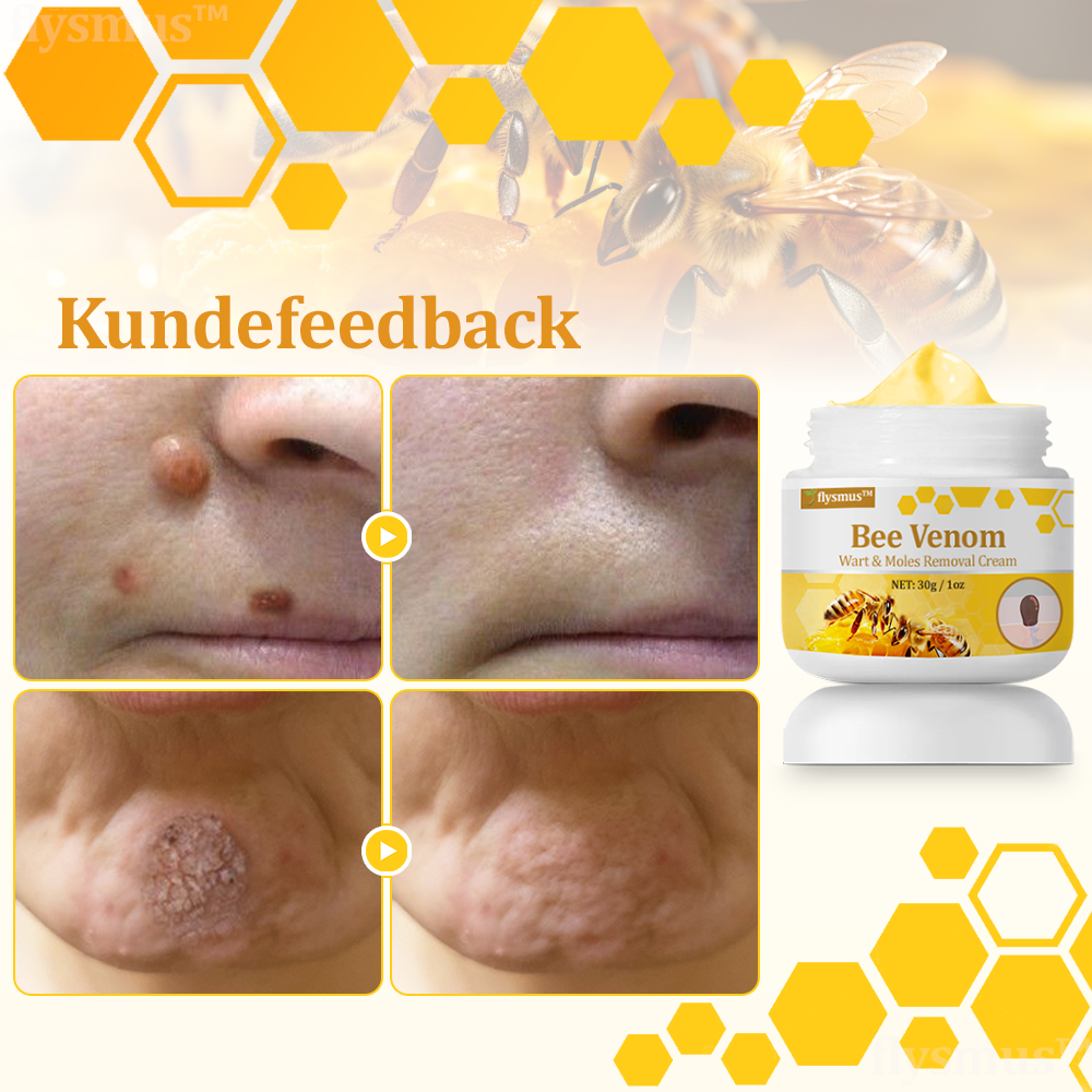 🧑‍⚕️flysmus™ Creme mod Hudflap & Vorter, Hjælper med at behandle vedvarende vorter, hudvækster, hudlæsioner, infektioner, ardannelse og udglatte ujævn hud✨