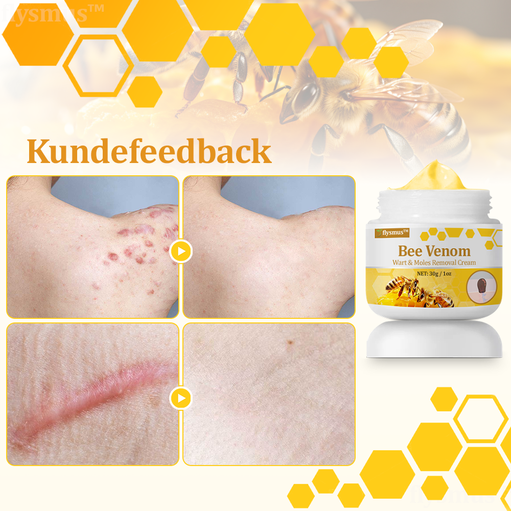 🧑‍⚕️flysmus™ Creme mod Hudflap & Vorter, Hjælper med at behandle vedvarende vorter, hudvækster, hudlæsioner, infektioner, ardannelse og udglatte ujævn hud✨