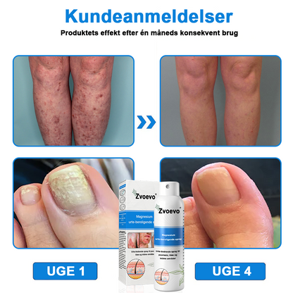 ✅ Officiel butik: Zvoevo® Magnesium Urte-psoriasis Spray (Lindrer psoriasis og eksem, behandler rosacea og akne, forbedrer bakterielle infektioner i kønsområdet)