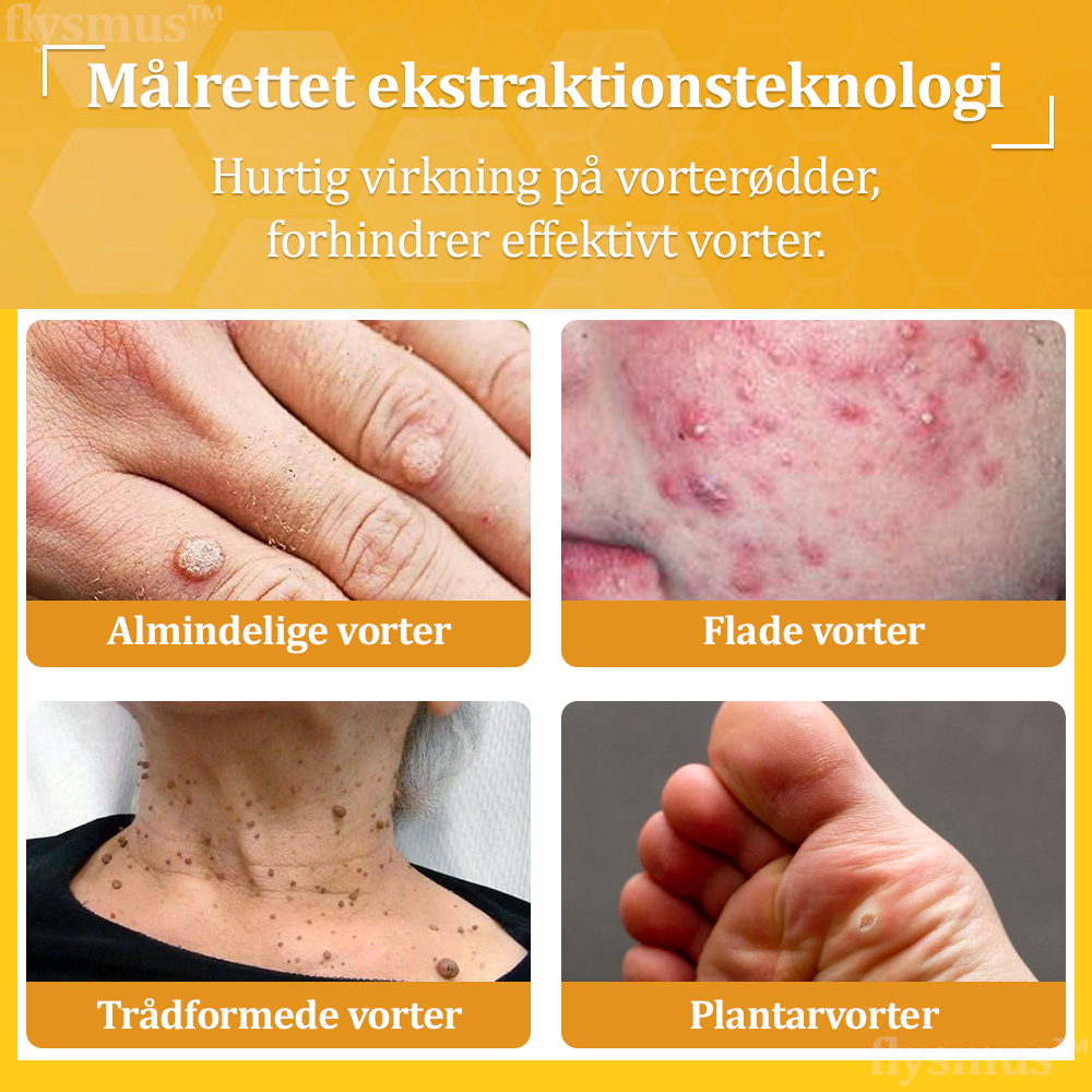 🧑‍⚕️flysmus™ Creme mod Hudflap & Vorter, Hjælper med at behandle vedvarende vorter, hudvækster, hudlæsioner, infektioner, ardannelse og udglatte ujævn hud✨