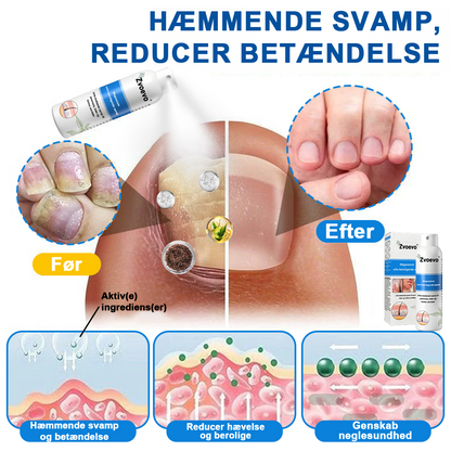 ✅ Officiel butik: Zvoevo® Magnesium Urte-psoriasis Spray (Lindrer psoriasis og eksem, behandler rosacea og akne, forbedrer bakterielle infektioner i kønsområdet)