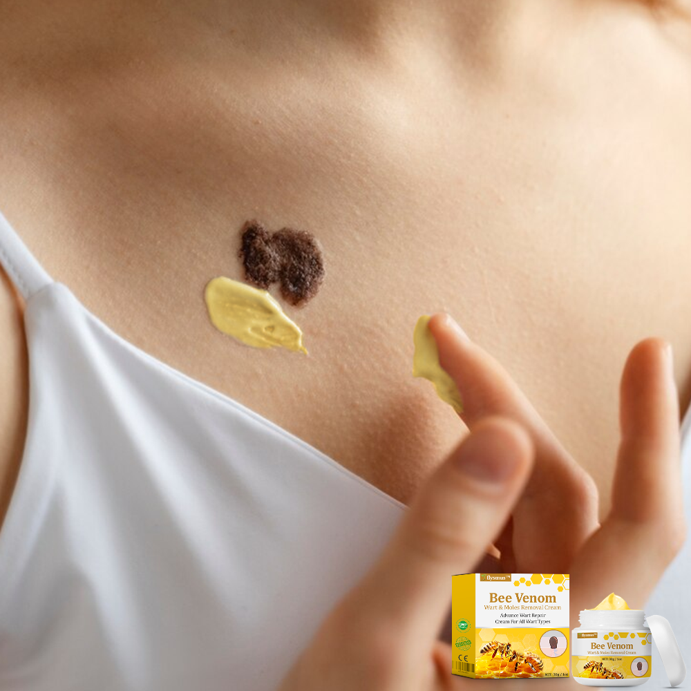 🧑‍⚕️flysmus™ Creme mod Hudflap & Vorter, Hjælper med at behandle vedvarende vorter, hudvækster, hudlæsioner, infektioner, ardannelse og udglatte ujævn hud✨