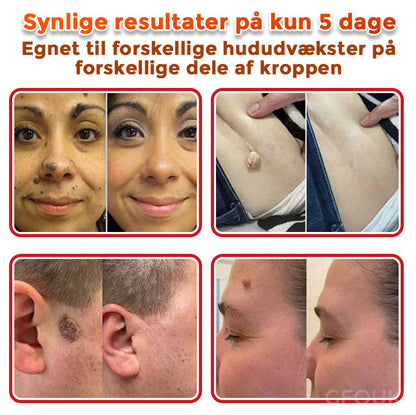 GFOUK® Botanisk Mikronålplaster til fjernelse af hudmærker